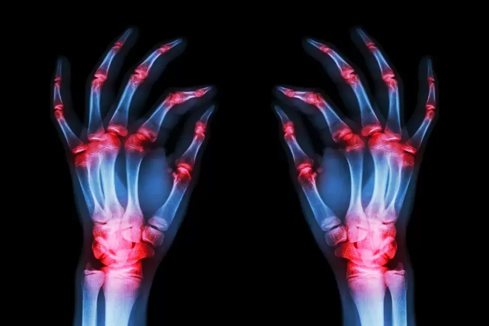 pirkstu locītavu artroze
