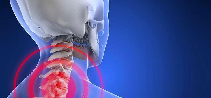 Dzemdes kakla reģiona osteohondroze