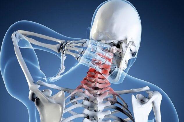 Dzemdes kakla reģiona osteohondroze