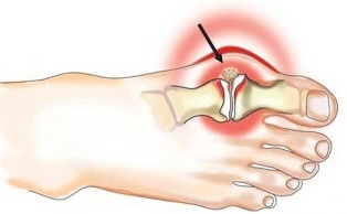 Locītavas iekaisums starp īkšķi un pēdu artrīta gadījumā