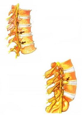 mugurkaula osteohondrozes ilustrācija