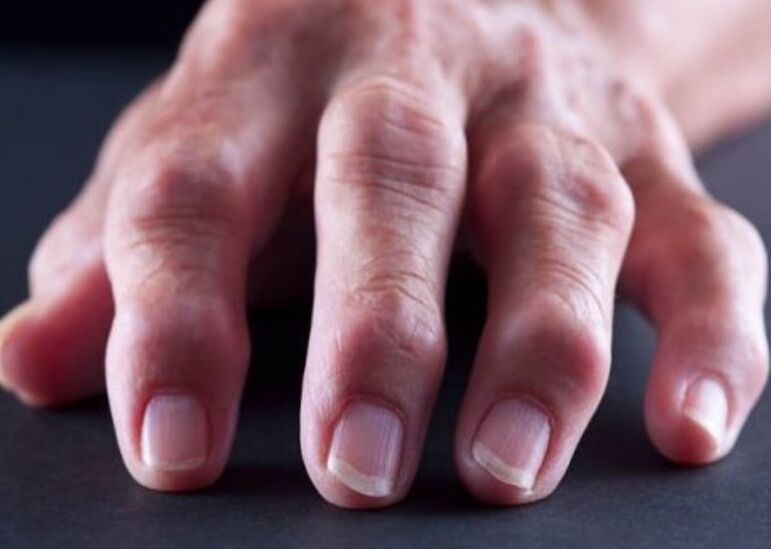 reimatoīdais artrīts kā sāpju cēlonis pirkstu locītavās