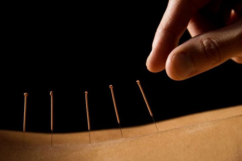 akupunktūra muguras sāpēm